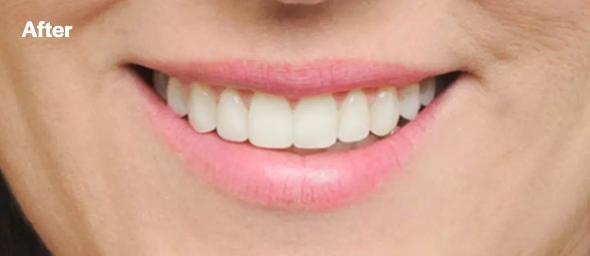 Eksempel fra Damon Orthodontics etter behandling som viser tannbuens form