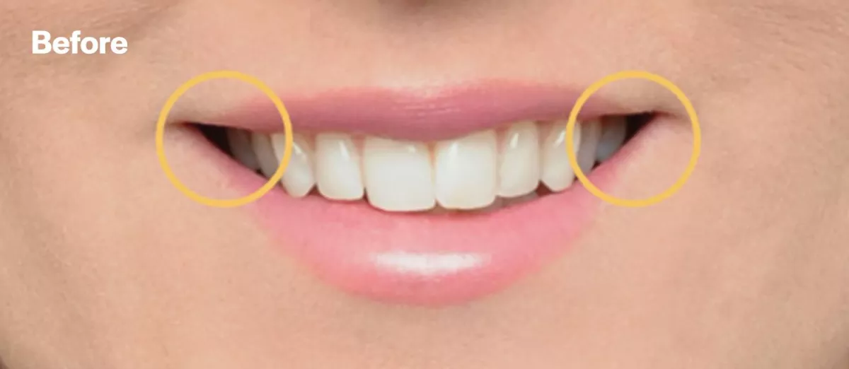 Eksempel fra Damon Orthodontics før behandling som viser tannbuens form