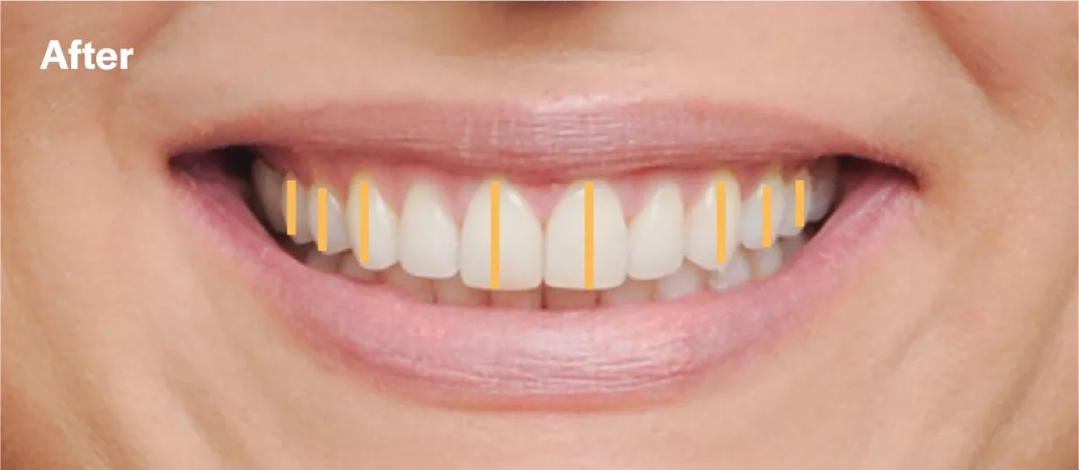 Eksempel fra Damon Orthodontics etter behandling som viser fortennenes plassering