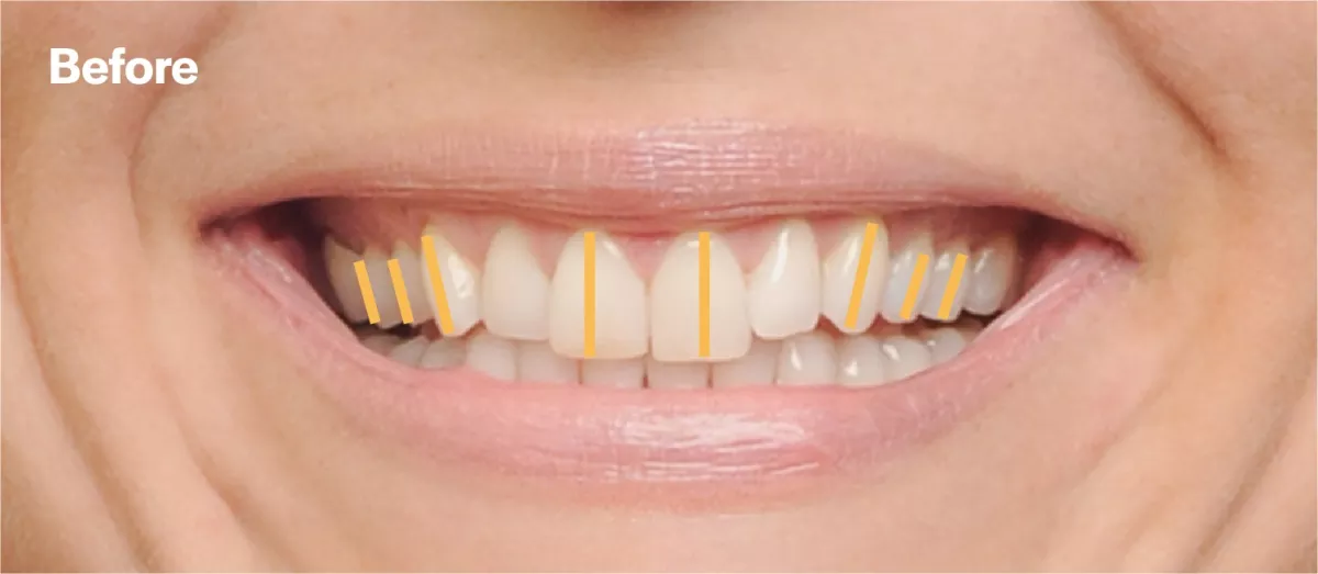 Eksempel fra Damon Orthodontics før behandling som viser fortennenes plassering