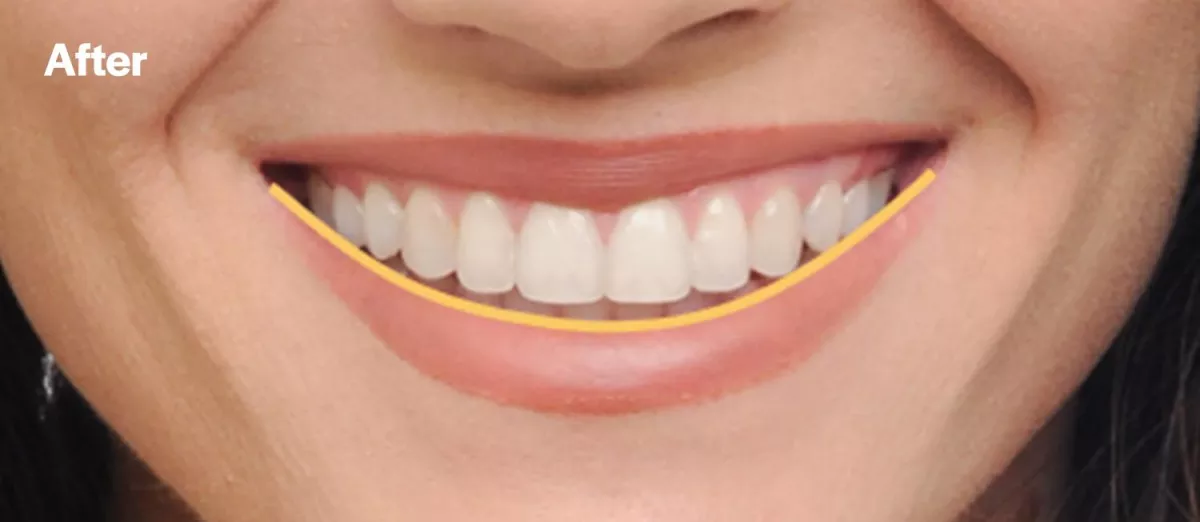Eksempel fra Damon Orthodontics etter behandling som viser smilelinjen