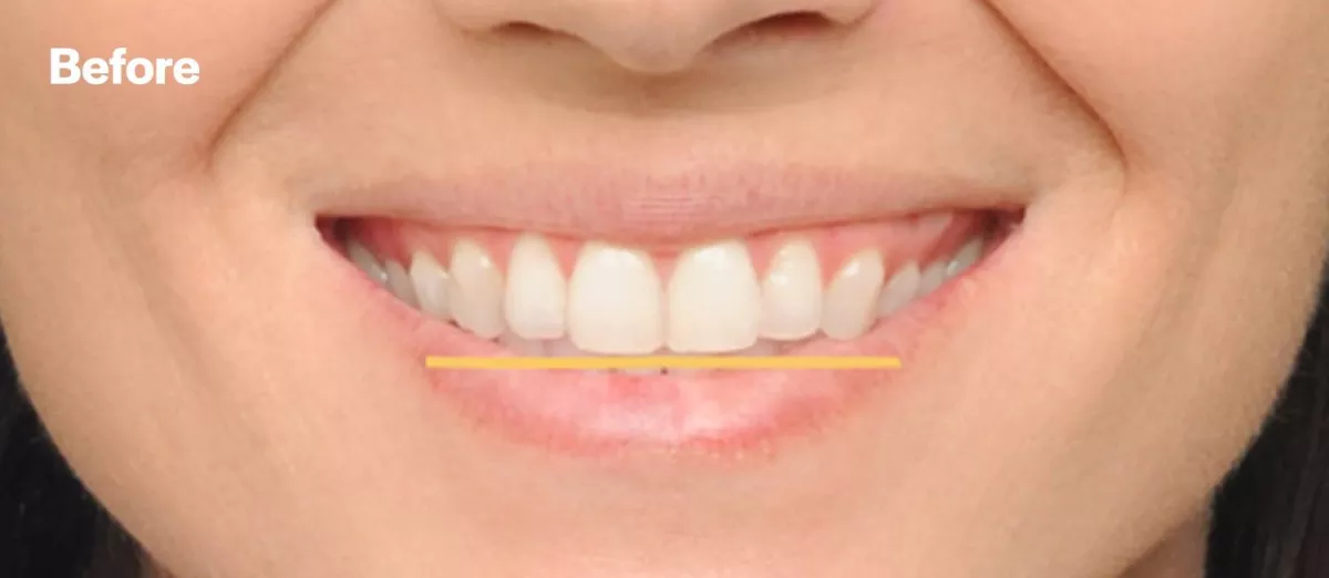 Eksempel fra Damon Orthodontics før behandling som viser smilelinjen